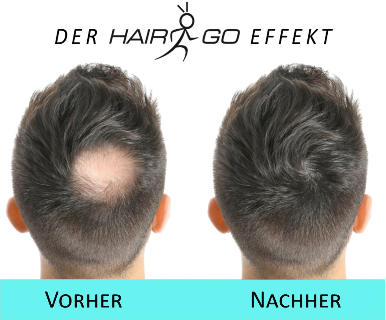 HairGo Vorher-Nachher Mann